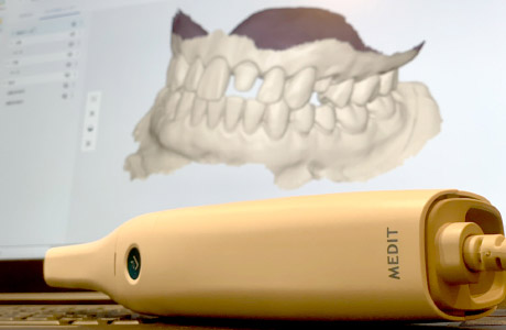 口腔内3Dスキャナー(iTero)による正確な歯型採取
