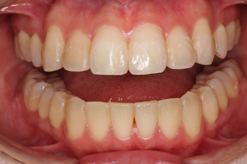 成人矯正の症例3