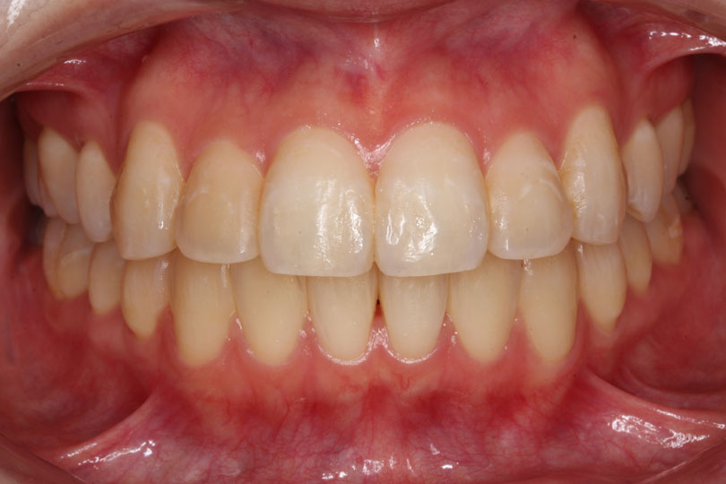 成人矯正の症例4