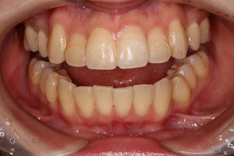 成人矯正の症例1