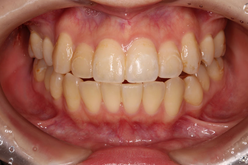 成人矯正の症例2