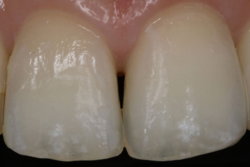 ホワイトスポット治療症例写真2