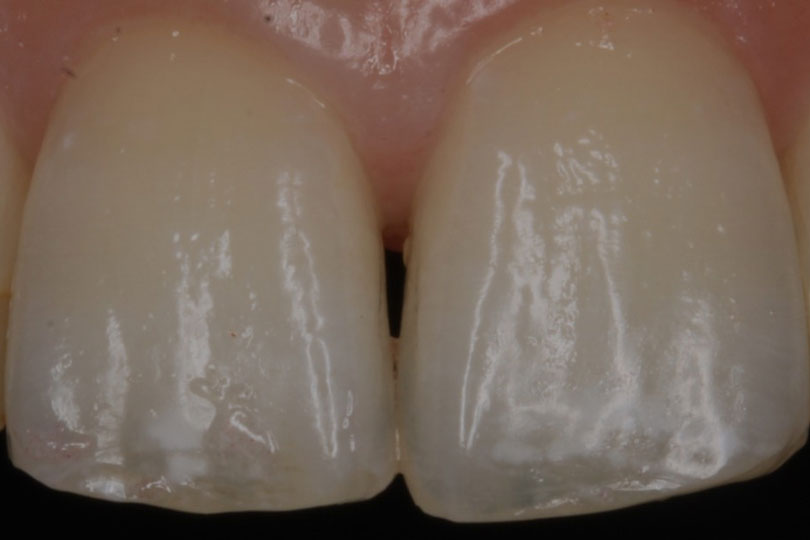 ホワイトスポット治療症例写真1